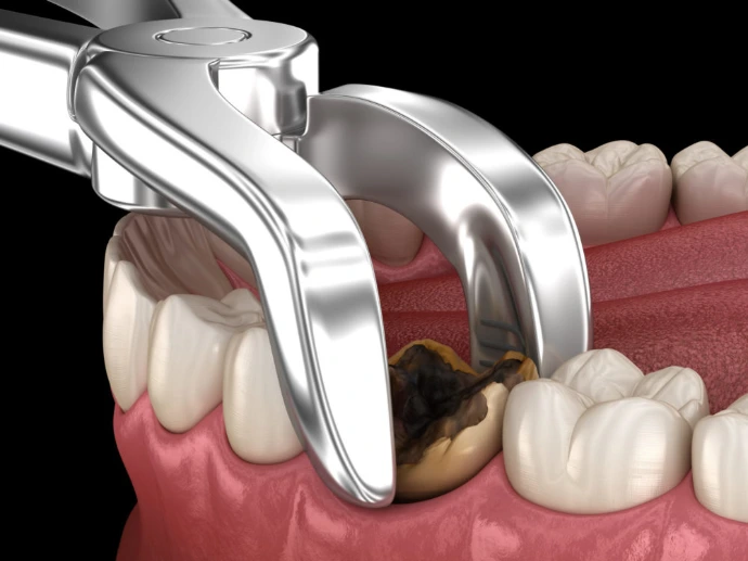 is it necessary to remove tooth