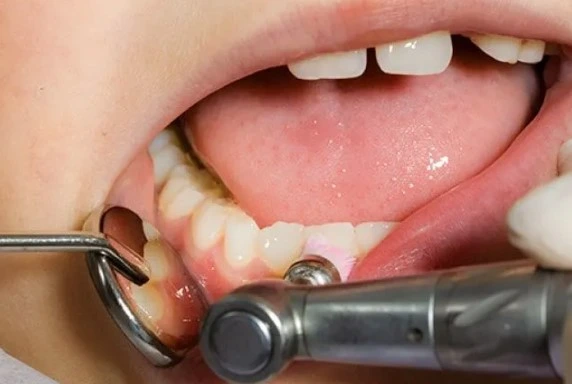 what is difference between teeth cleaning and polishing