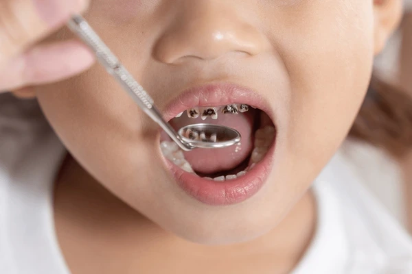 children teeth cavities