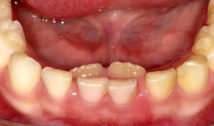 milk tooth not fallen