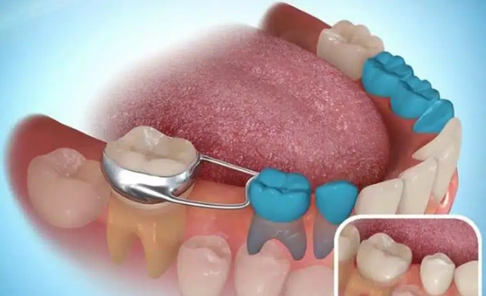 space maintainer for teeth