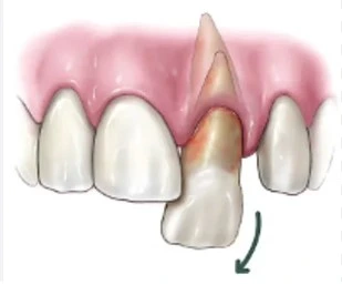 tooth came out