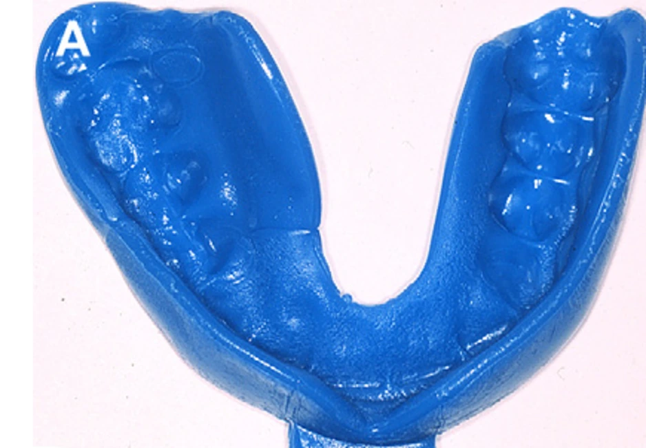 boil and bite mouthguard vs custom mouthguard