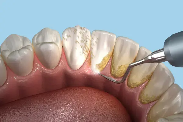 teeth cleaning
