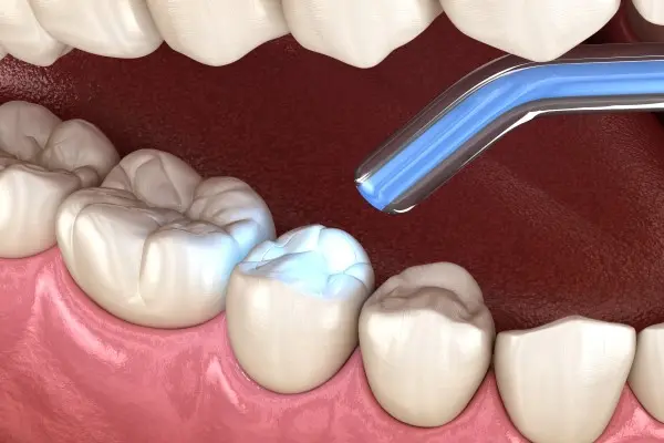 dental filling