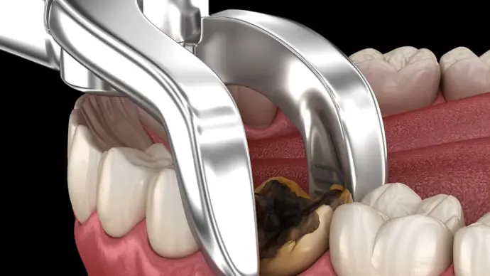 teeth extraction