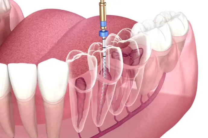 rootcanal treatment