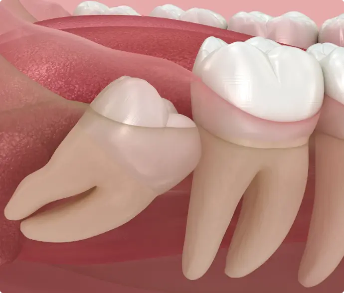 wisdom tooth